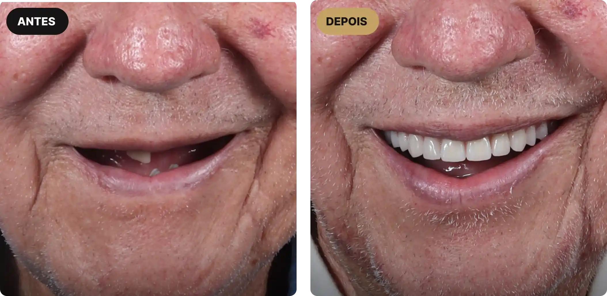 implante-dentario-em-sao-paulo-2