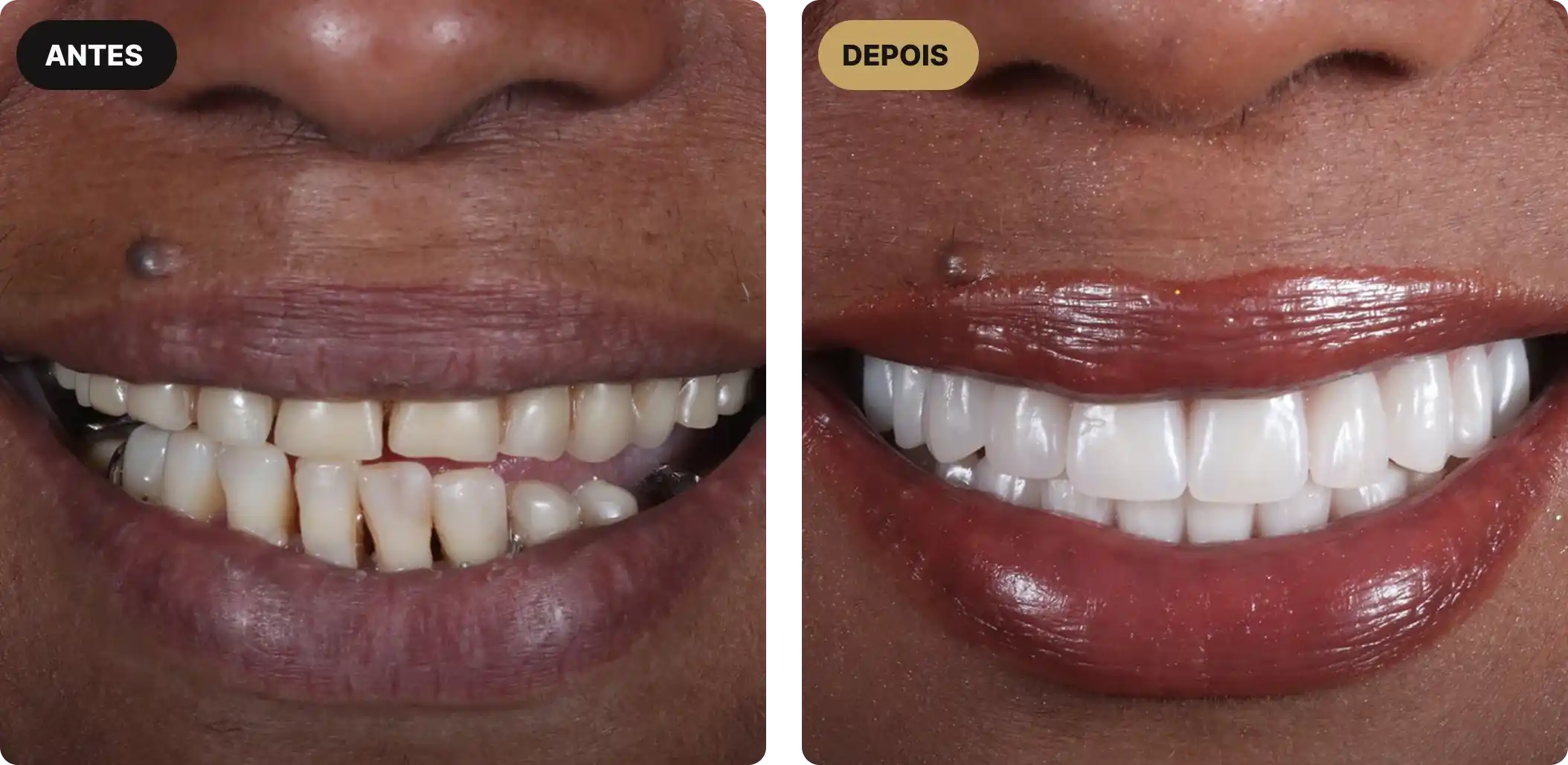 implante-dentario-em-sao-paulo-3