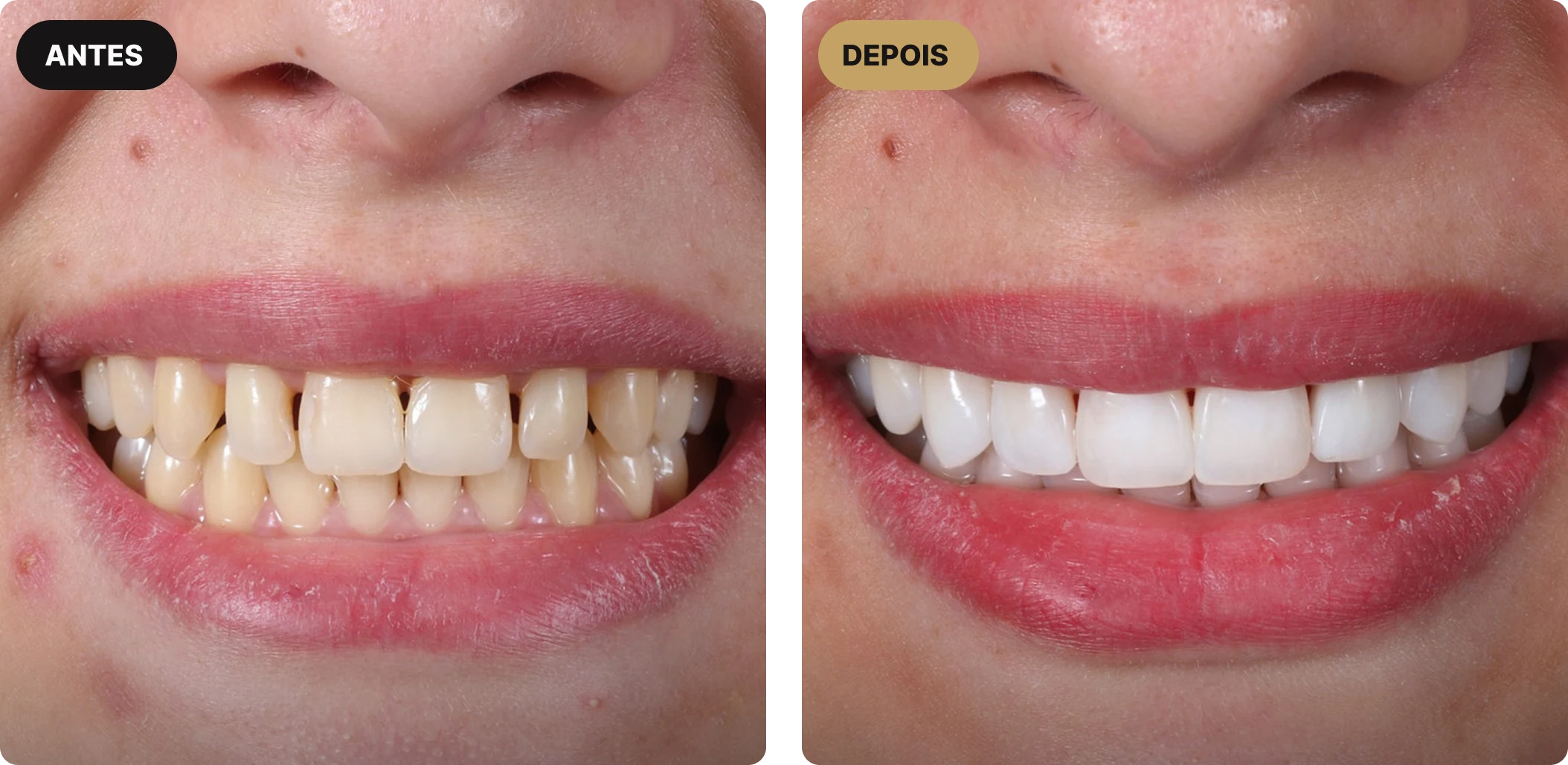 implante-dentario-em-sao-paulo-4