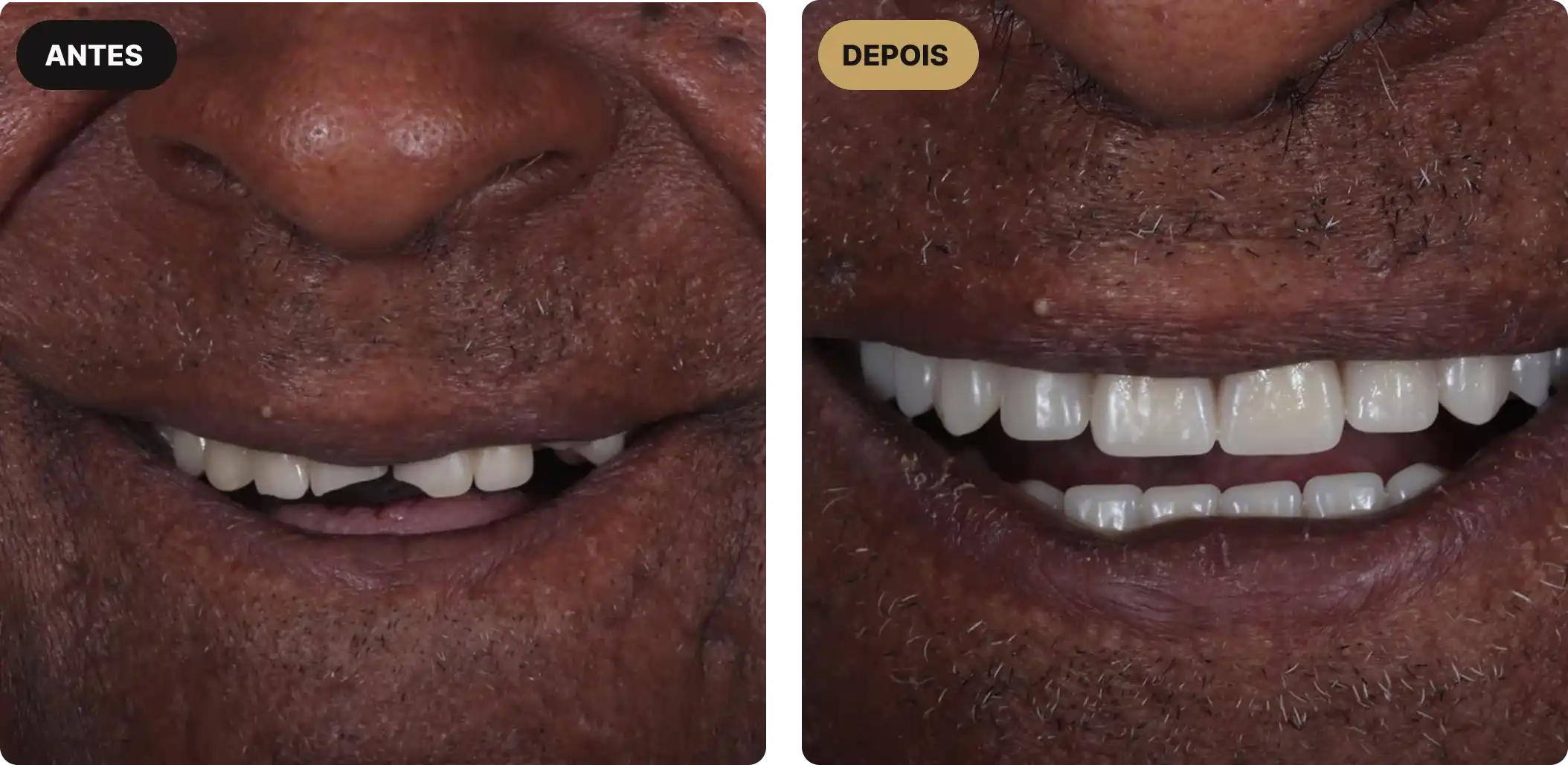 implante-dentario-em-sao-paulo-5