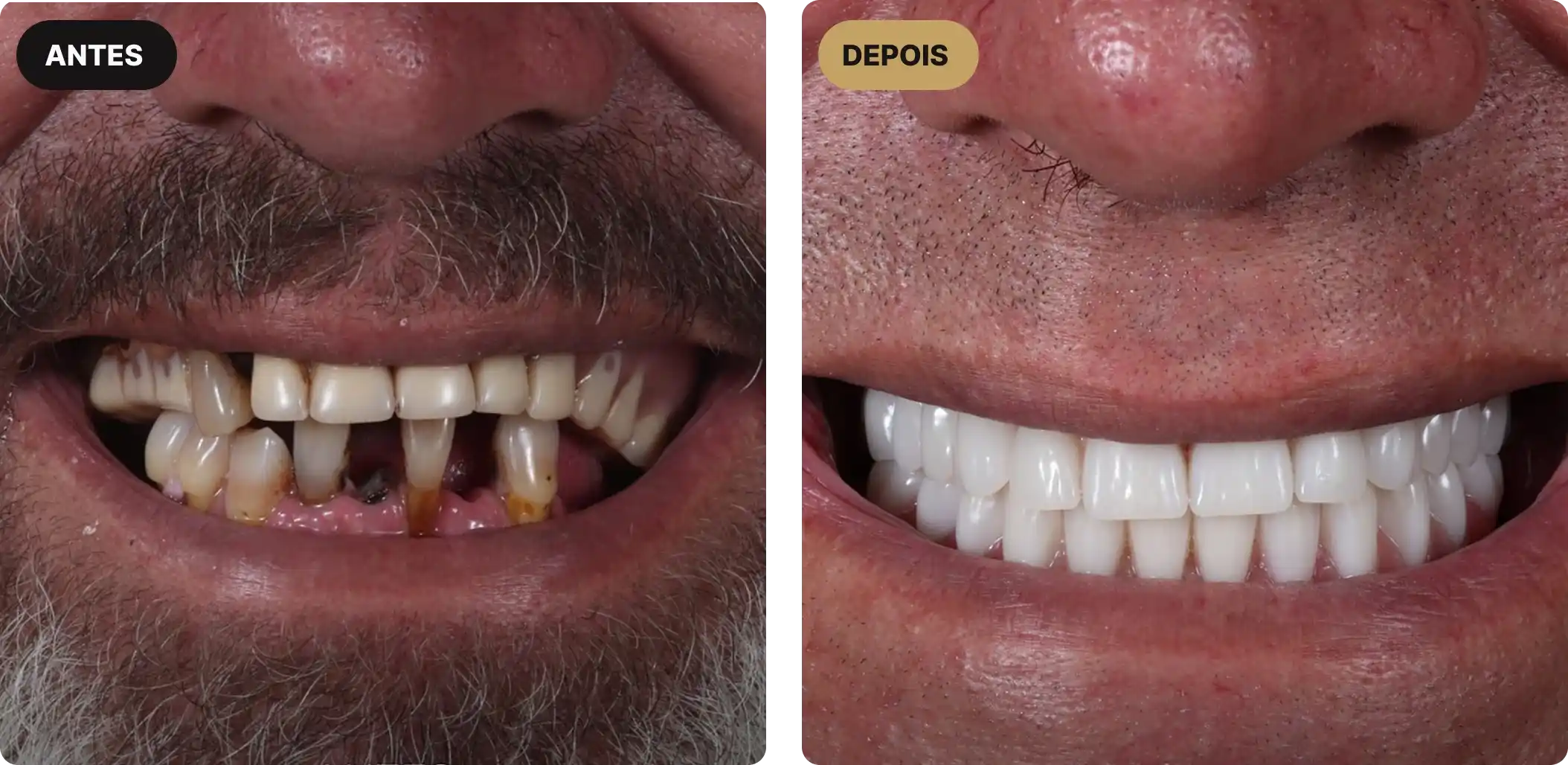 implante-dentario-em-sao-paulo-6