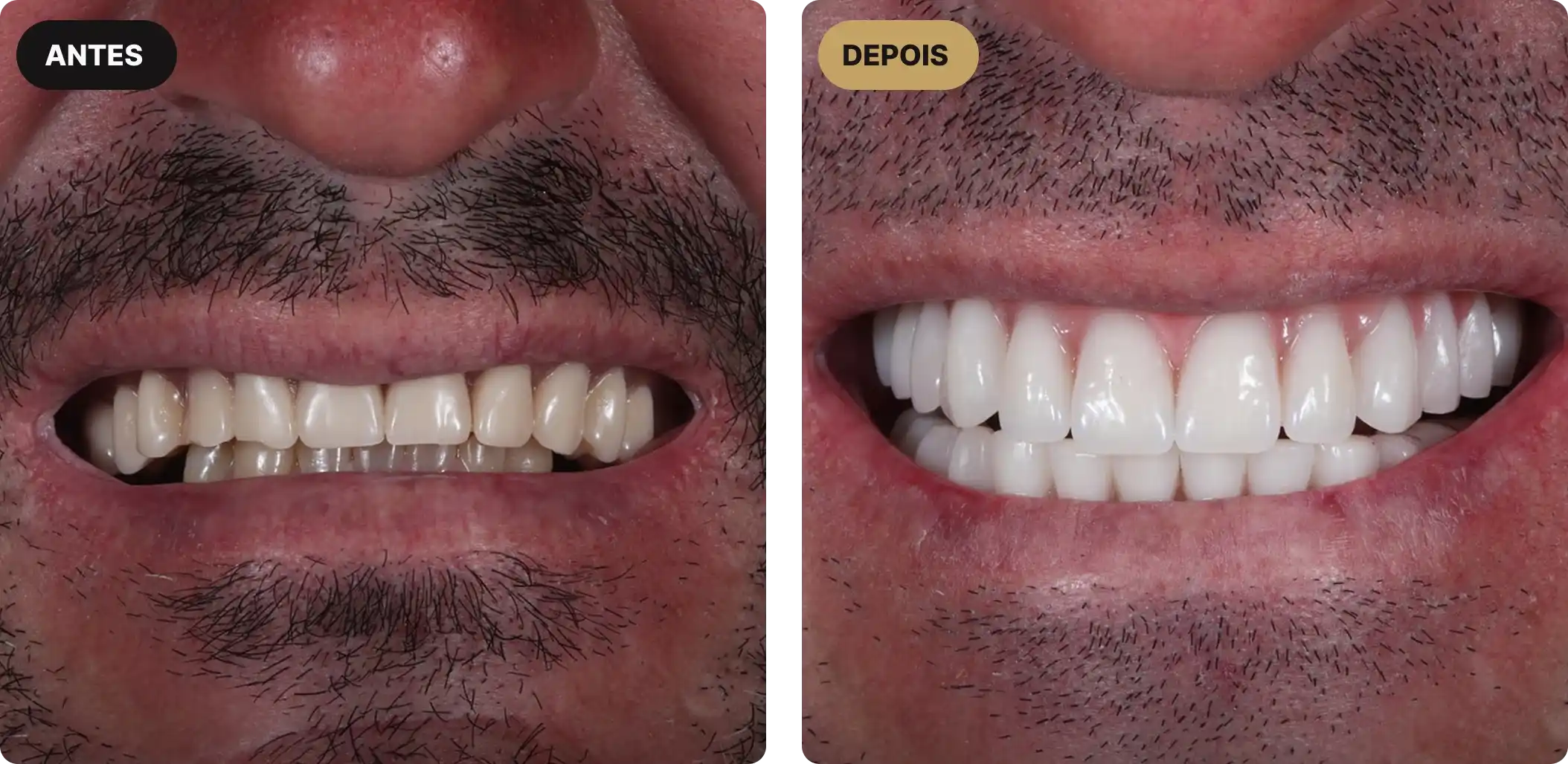 implante-dentario-em-sao-paulo-7