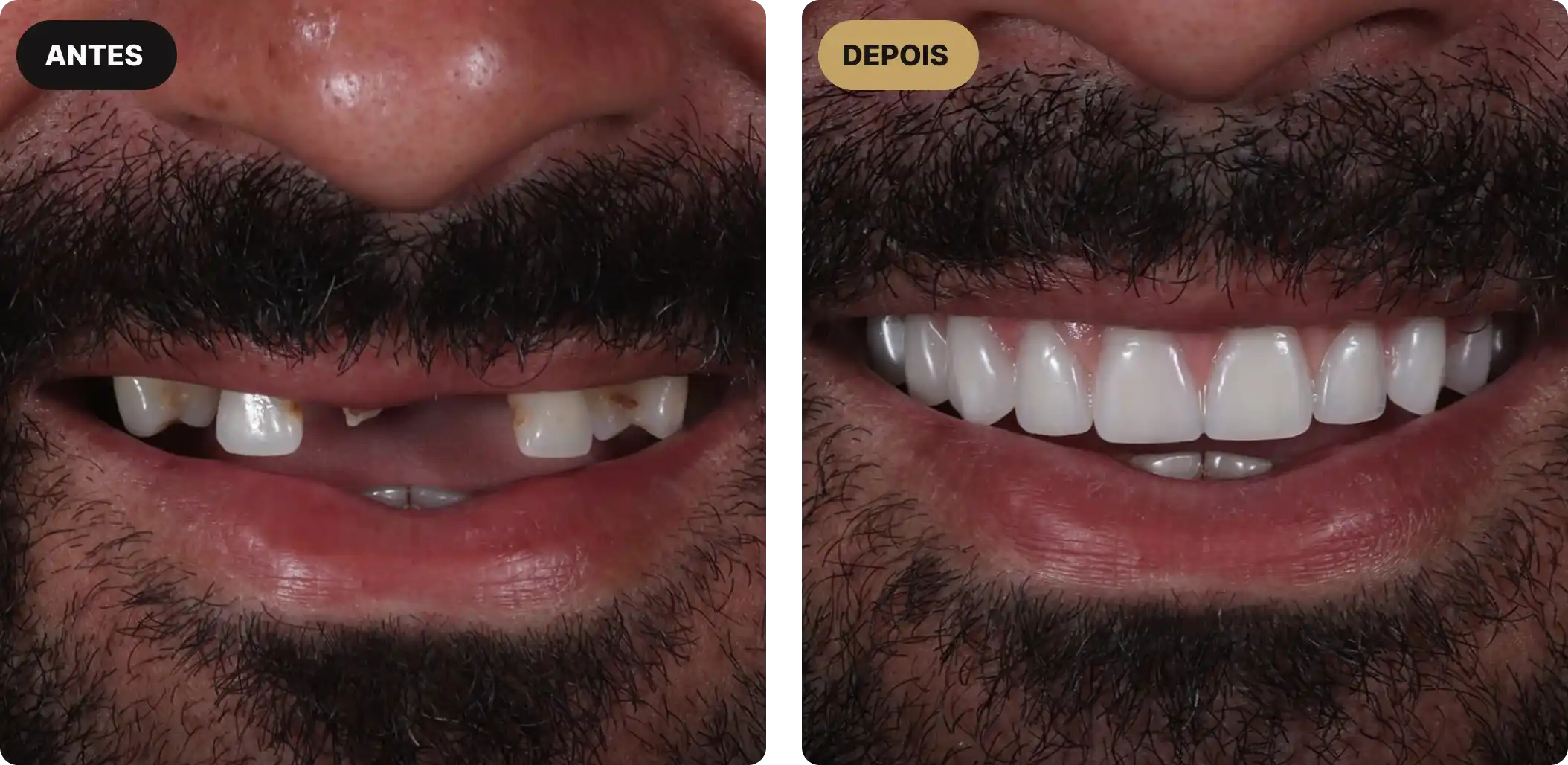 implante-dentario-em-sao-paulo-8