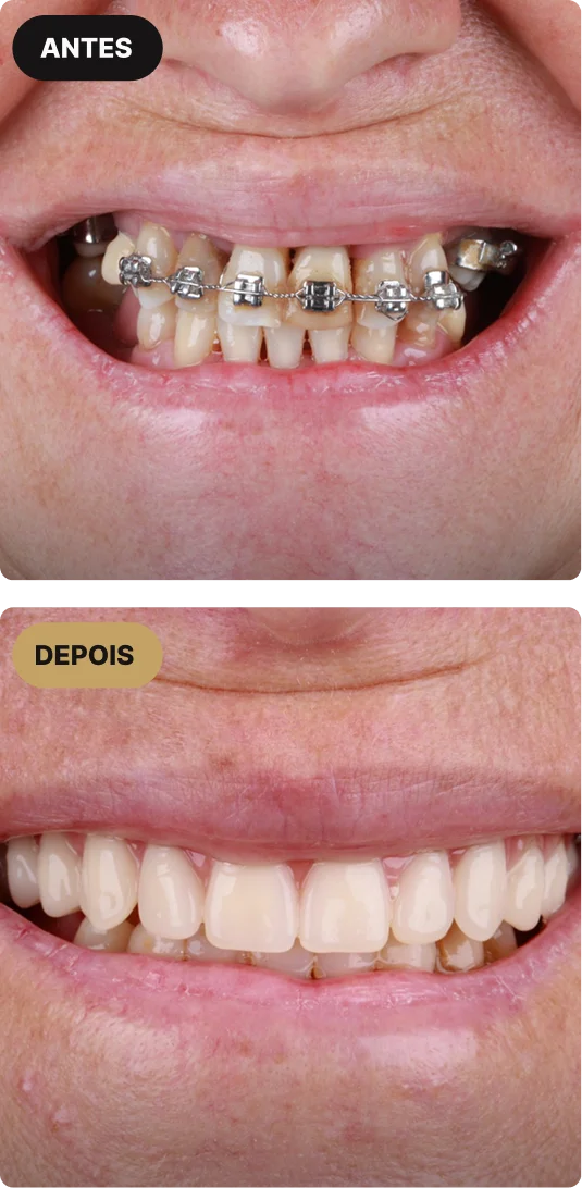 implante-dentario-em-sao-paulo-mobile-1