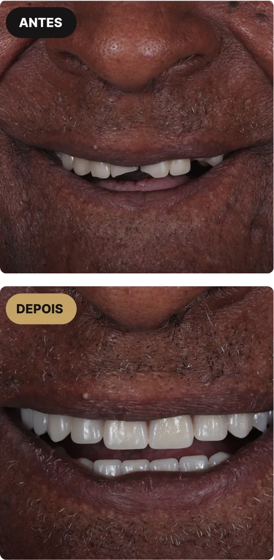 implante-dentario-em-sao-paulo-mobile-2