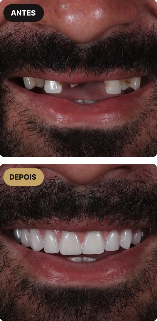 implante-dentario-em-sao-paulo-mobile-3