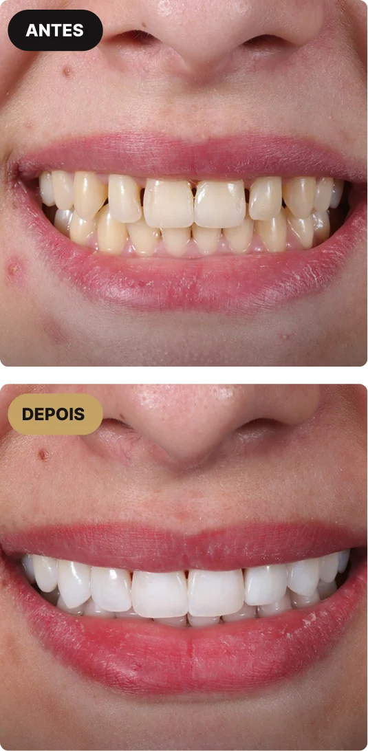 implante-dentario-em-sao-paulo-mobile-4