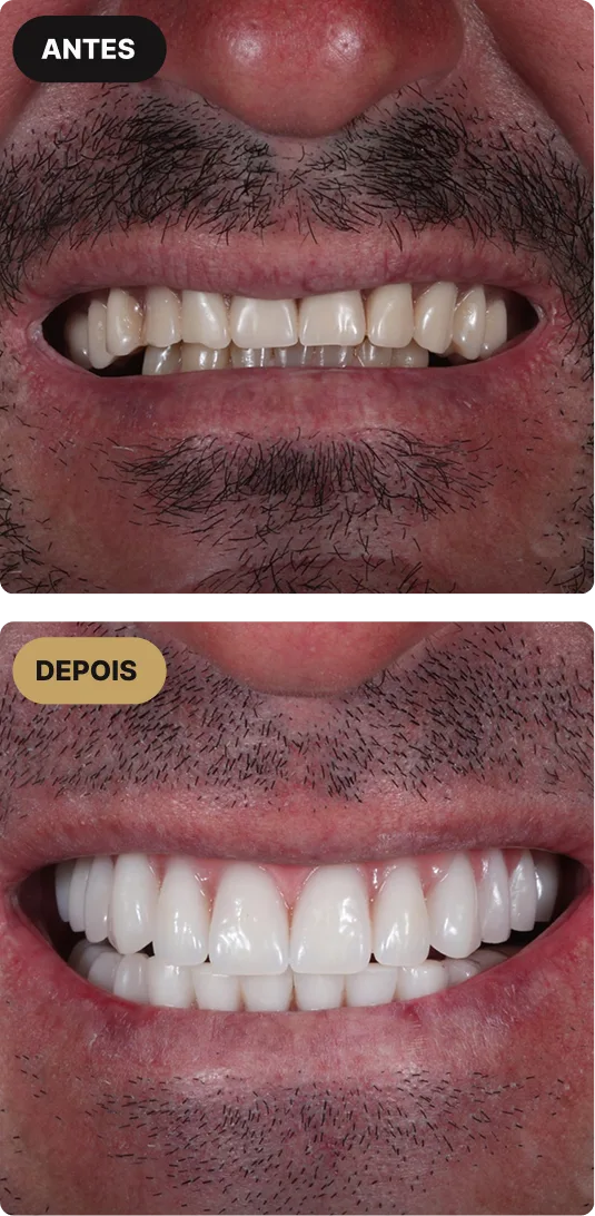 implante-dentario-em-sao-paulo-mobile-5