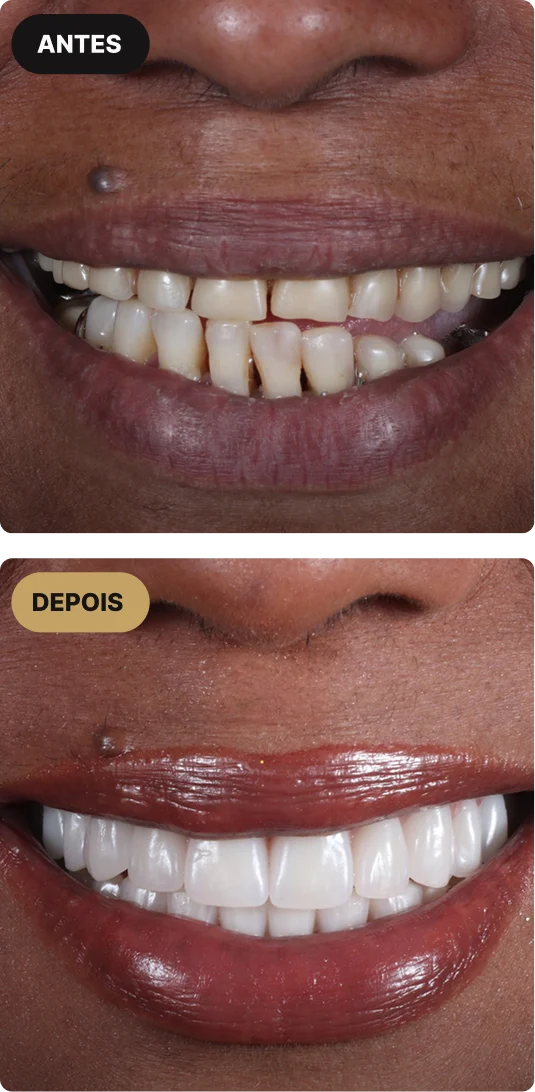 implante-dentario-em-sao-paulo-mobile-6