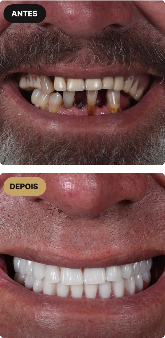 implante-dentario-em-sao-paulo-mobile-7