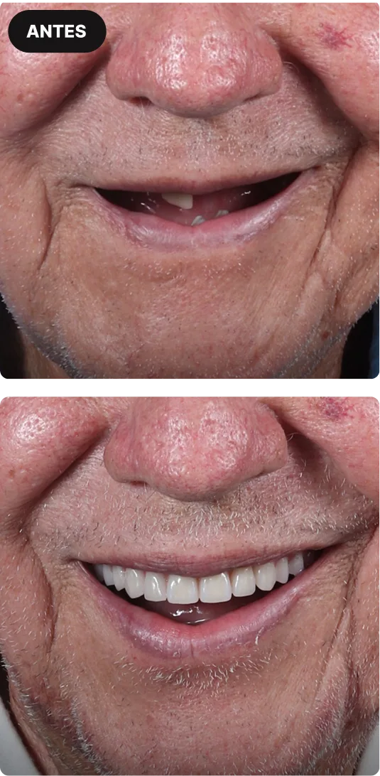 implante-dentario-em-sao-paulo-mobile-8