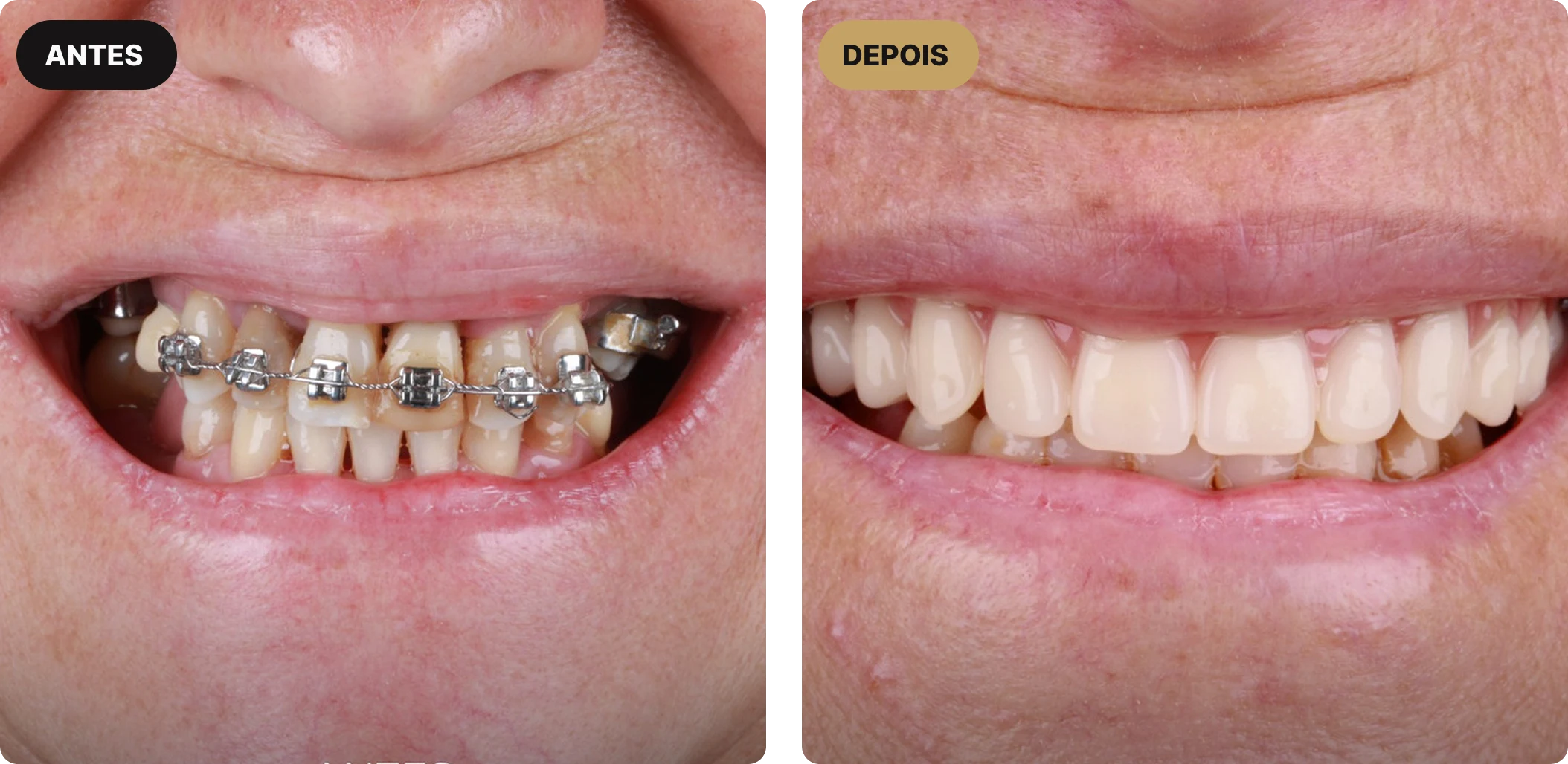 implante-dentario-em-sao-paulo